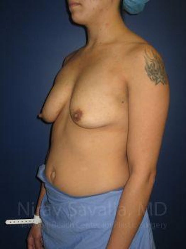 Breast Lift with Implants Before & After Gallery - Patient 1655508 - Before1