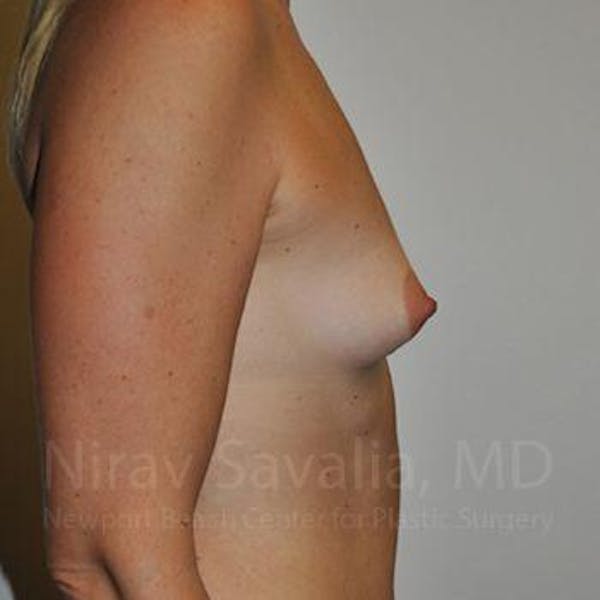 Breast Augmentation Before & After Gallery - Patient 1655512 - Before1
