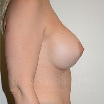 Breast Augmentation Before & After Gallery - Patient 1655512 - After1