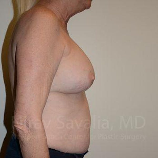Breast Implant Revision Before & After Gallery - Patient 1655513 - Before1