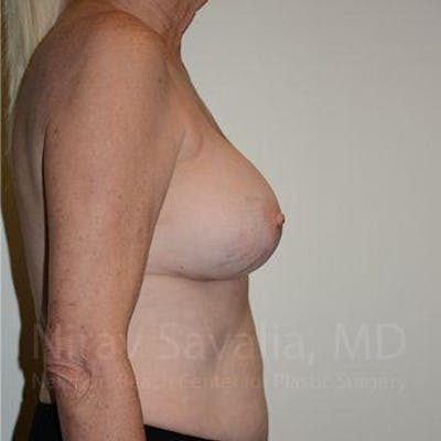 Breast Implant Revision Before & After Gallery - Patient 1655513 - After1