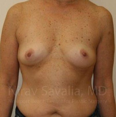 Breast Augmentation Before & After Gallery - Patient 1655519