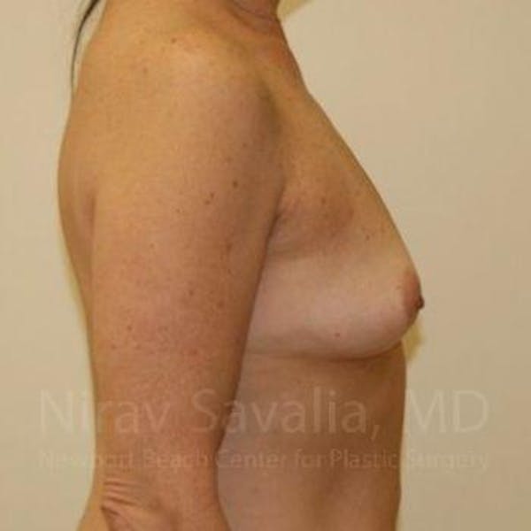 Eyelid Surgery Before & After Gallery - Patient 1655519 - Before1