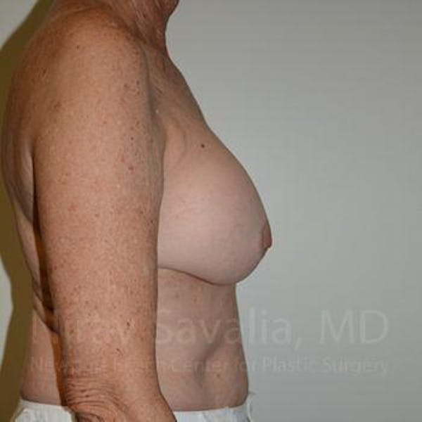 Breast Implant Revision Before & After Gallery - Patient 1655520 - Before1