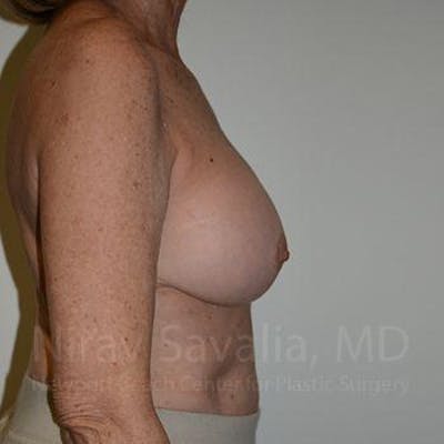 Breast Implant Revision Before & After Gallery - Patient 1655520 - After1