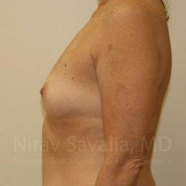 Eyelid Surgery Before & After Gallery - Patient 1655519 - Before1