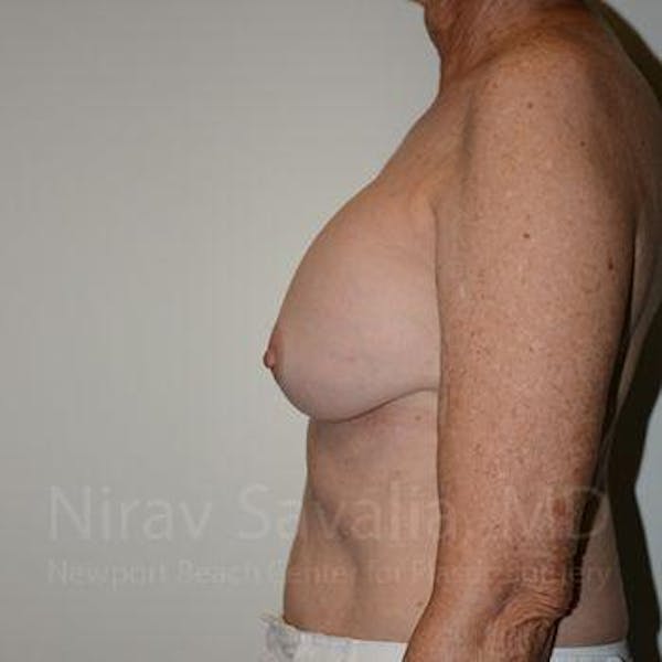 Breast Implant Revision Before & After Gallery - Patient 1655520 - Before1
