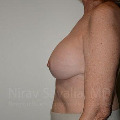 Breast Implant Revision Before & After Gallery - Patient 1655520 - After1