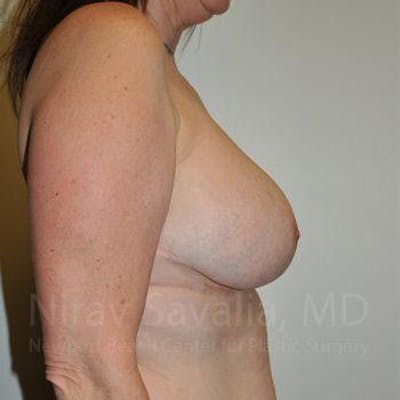 Breast Lift with Implants Before & After Gallery - Patient 1655526 - After1