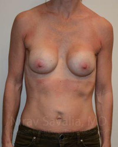 Breast Implant Revision Before & After Gallery - Patient 1655536
