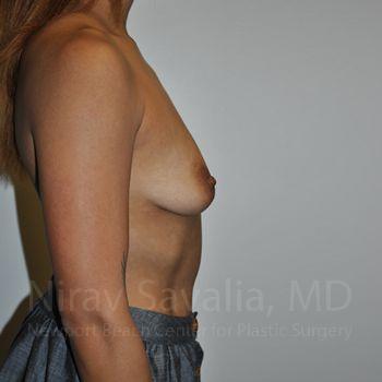 Breast Augmentation Before & After Gallery - Patient 1655537 - Before1