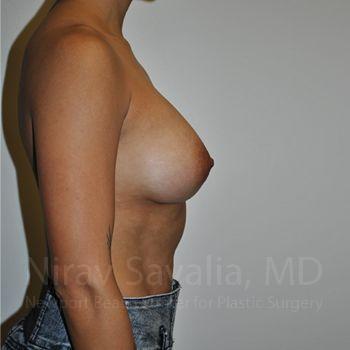 Breast Augmentation Before & After Gallery - Patient 1655537 - After1