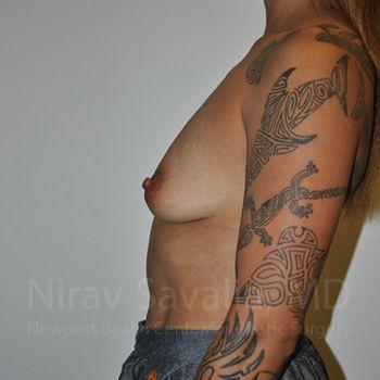 Breast Augmentation Before & After Gallery - Patient 1655537 - Before1