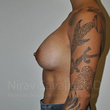 Breast Augmentation Before & After Gallery - Patient 1655537 - After1