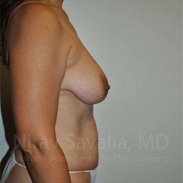 Breast Lift with Implants Before & After Gallery - Patient 1655542 - Before1