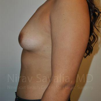 Breast Augmentation Before & After Gallery - Patient 1655544 - Before1