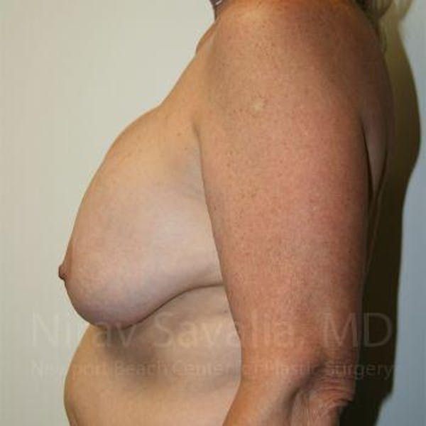 Breast Implant Revision Before & After Gallery - Patient 1655545 - Before1