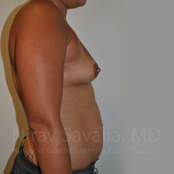 Breast Augmentation Before & After Gallery - Patient 1655546 - Before1