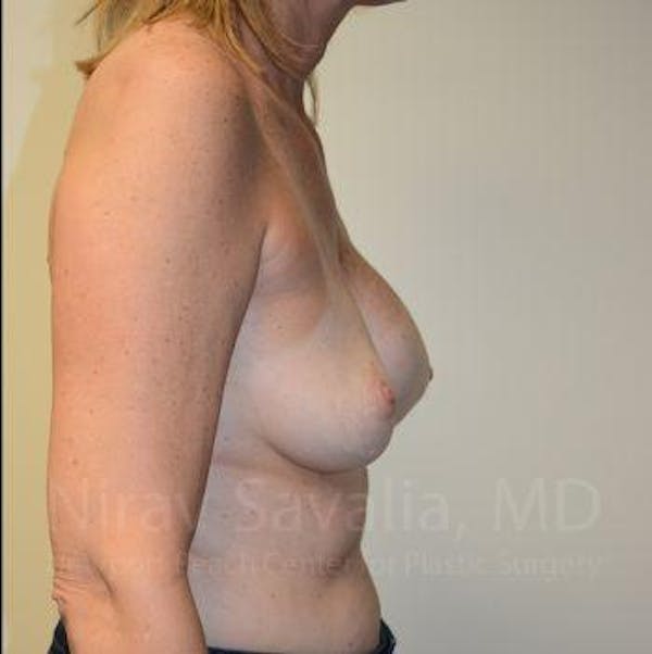 Breast Implant Revision Before & After Gallery - Patient 1655547 - Before1