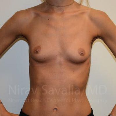 Breast Augmentation Before & After Gallery - Patient 1655548