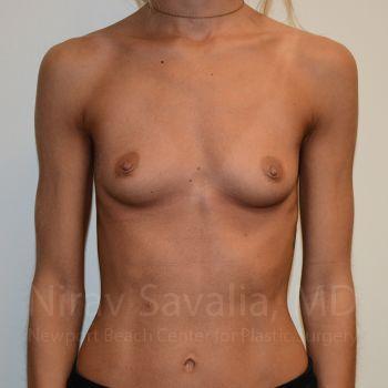 Breast Augmentation Before & After Gallery - Patient 1655548 - Before1