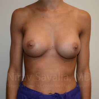 Breast Augmentation Before & After Gallery - Patient 1655548 - After1