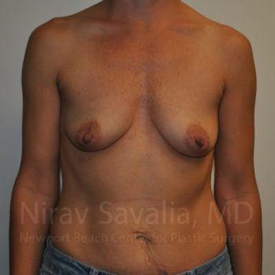 Breast Augmentation Before & After Gallery - Patient 1655550