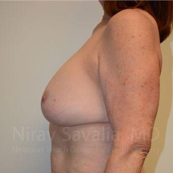 Breast Implant Revision Before & After Gallery - Patient 1655549 - Before1