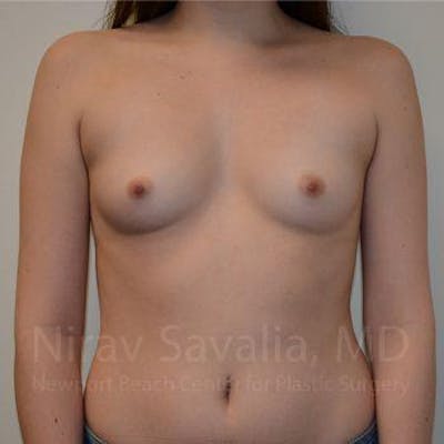 Breast Augmentation Before & After Gallery - Patient 1655555