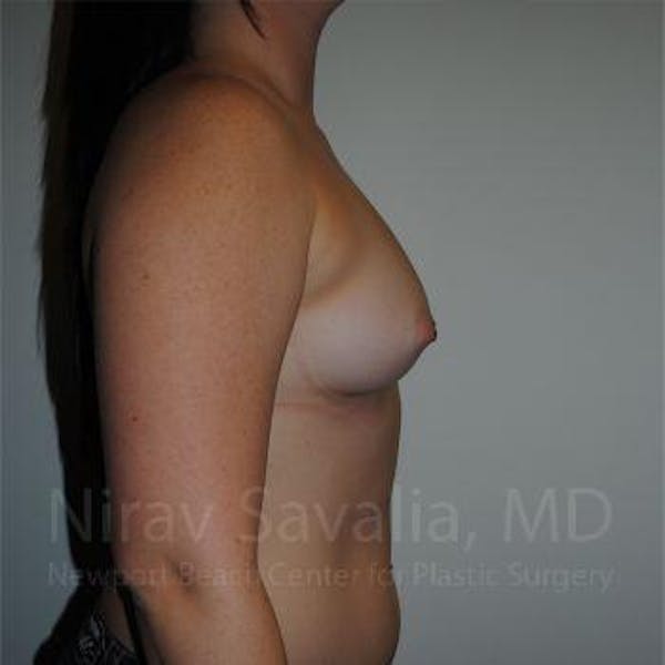 Breast Augmentation Before & After Gallery - Patient 1655559 - Before1