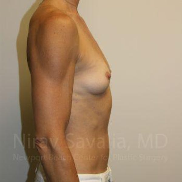 Breast Augmentation Before & After Gallery - Patient 1655561 - Before1