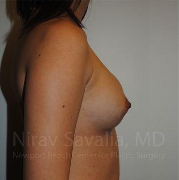 Breast Implant Revision Before & After Gallery - Patient 1655564 - Before1