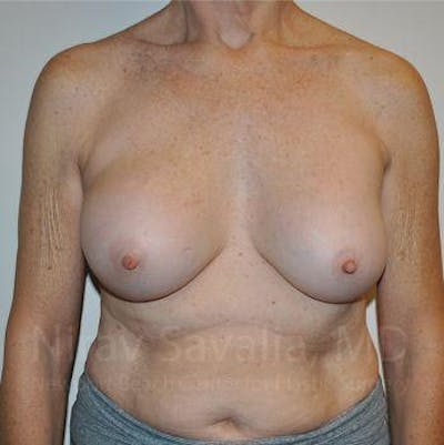Breast Implant Revision Before & After Gallery - Patient 1655567