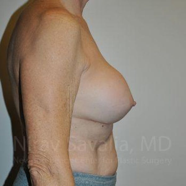 Breast Implant Revision Before & After Gallery - Patient 1655567 - Before1