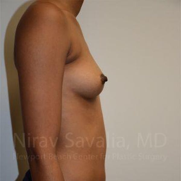 Breast Augmentation Before & After Gallery - Patient 1655568 - Before1