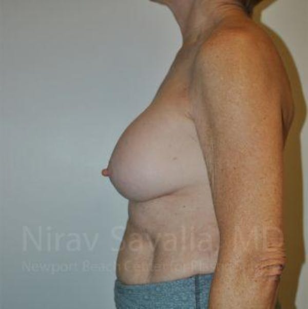 Breast Implant Revision Before & After Gallery - Patient 1655567 - Before1
