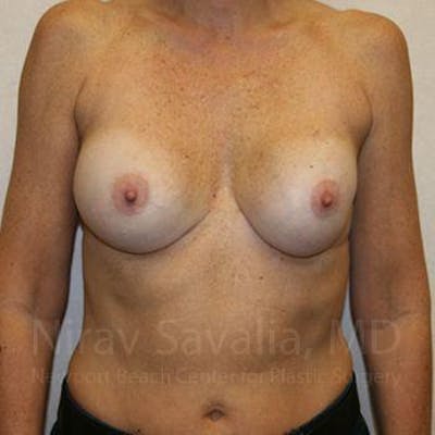 Breast Implant Revision Before & After Gallery - Patient 1655570