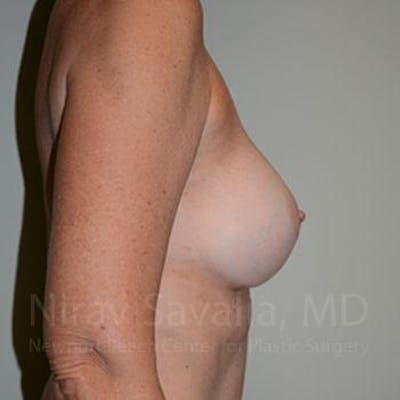 Breast Implant Revision Before & After Gallery - Patient 1655570 - After1