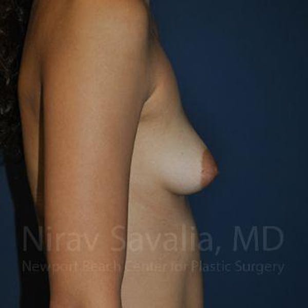 Breast Augmentation Before & After Gallery - Patient 1655573 - Before1