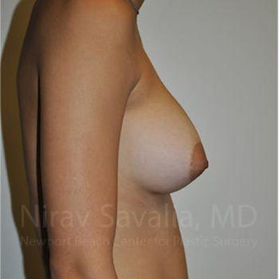 Breast Augmentation Before & After Gallery - Patient 1655573 - After1