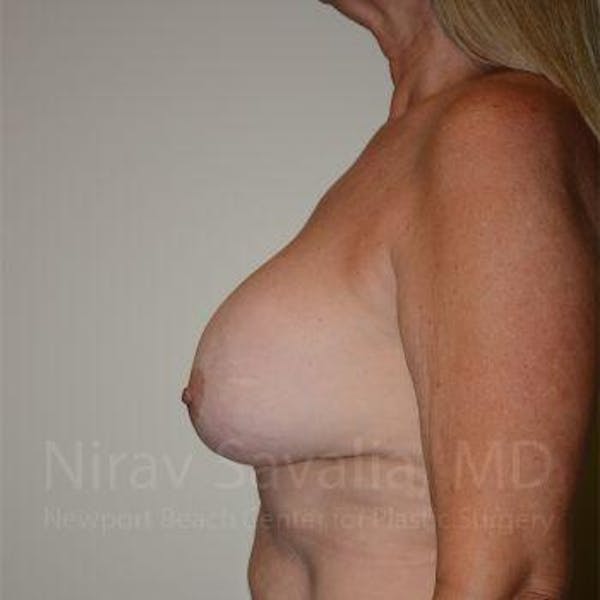 Breast Implant Revision Before & After Gallery - Patient 1655572 - Before1