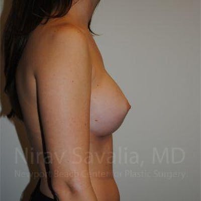 Breast Augmentation Before & After Gallery - Patient 1655574 - After1