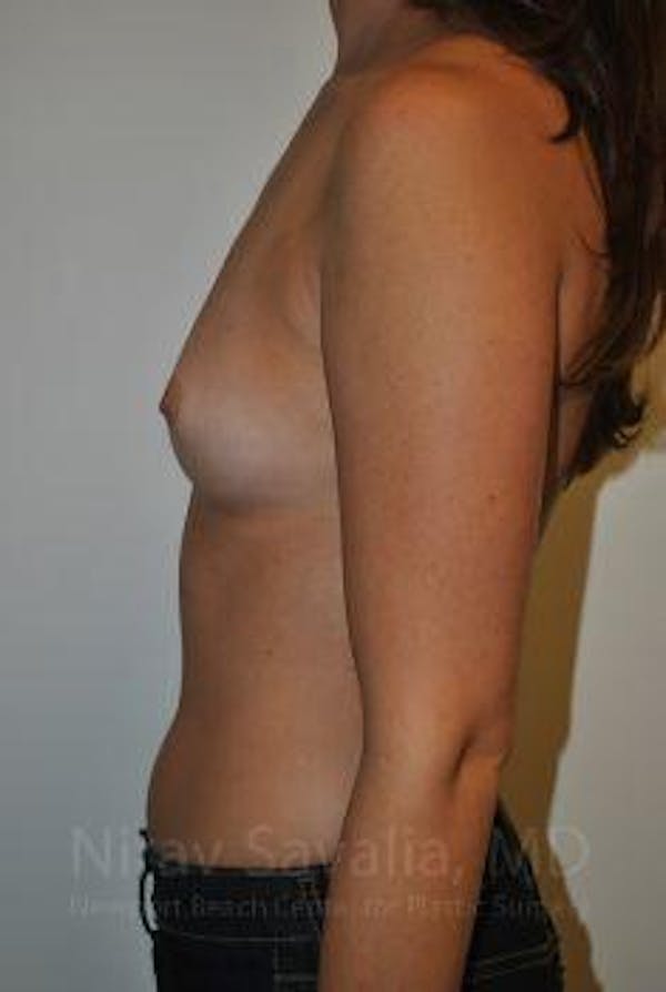 Breast Augmentation Before & After Gallery - Patient 1655574 - Before1