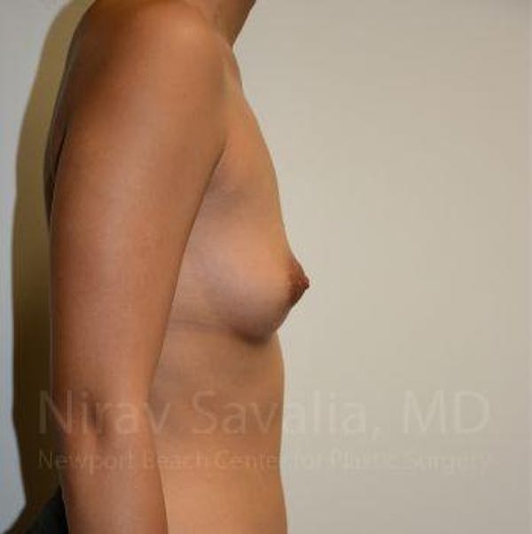 Breast Augmentation Before & After Gallery - Patient 1655575 - Before1
