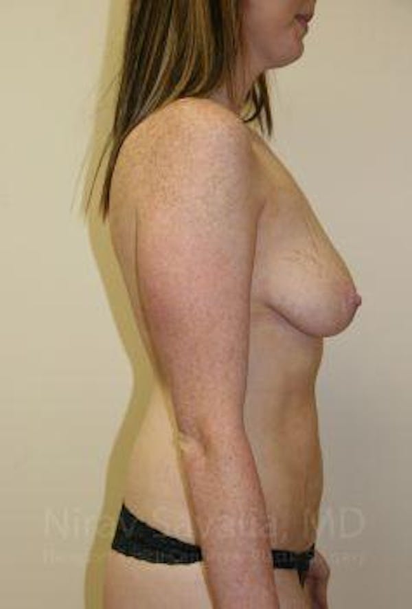 Breast Augmentation Before & After Gallery - Patient 1655579 - Before1