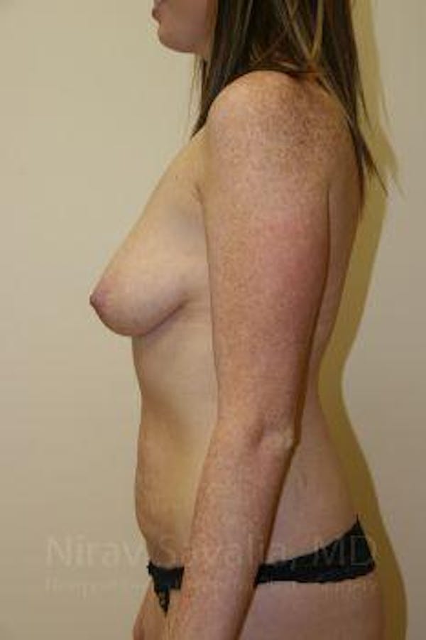 Breast Augmentation Before & After Gallery - Patient 1655579 - Before1