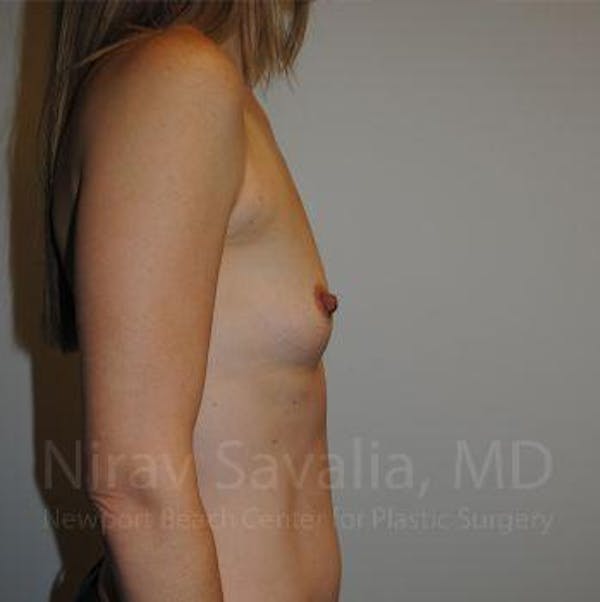 Breast Augmentation Before & After Gallery - Patient 1655580 - Before1