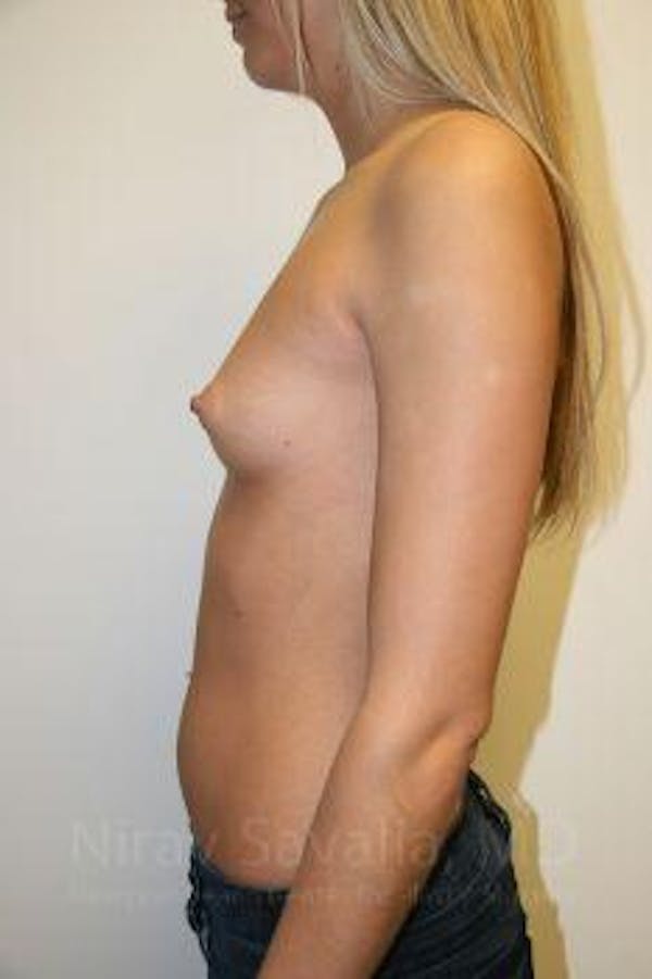 Breast Augmentation Before & After Gallery - Patient 1655581 - Before1