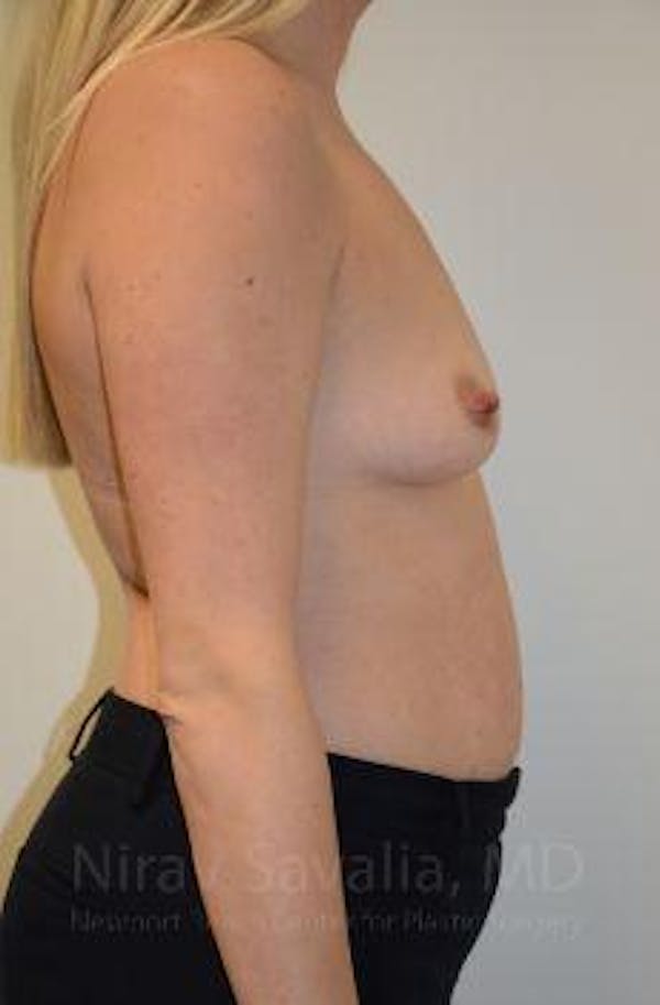 Breast Augmentation Before & After Gallery - Patient 1655585 - Before1