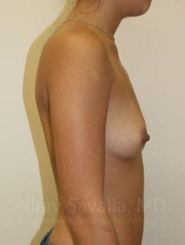 Breast Augmentation Before & After Gallery - Patient 1655586 - Before1